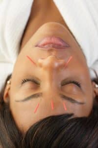 Is acupuncture becoming more popular?