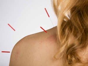 include on my acupuncture website