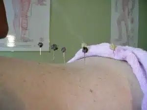 Showcasing techniques on acupuncture website Showcasing techniques on acupuncture website